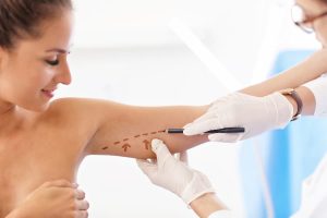 Surgeon marking patient’s arms for brachioplasty surgery